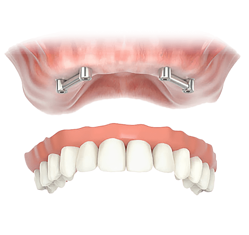 Stegprothese in Ungarn